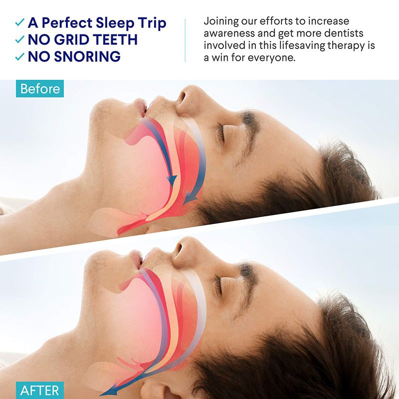 Капа От Бруксизма